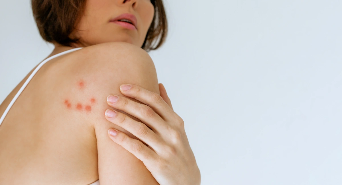 Woman gesturing to her back with bed bug bites 