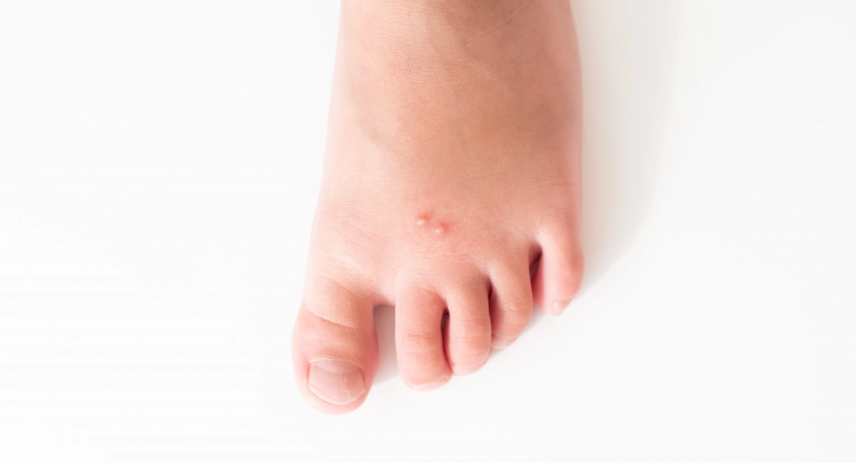 Fire ant bites on a child’s foot